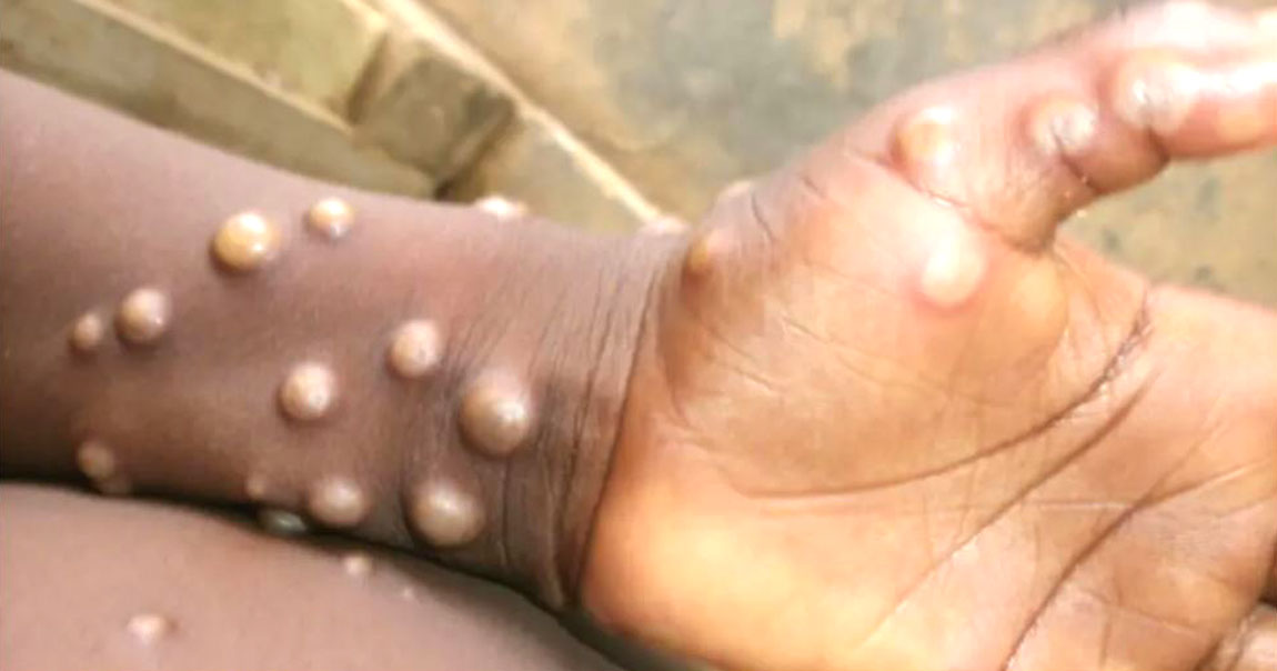 ७० बढी देशमा १६ हजारभन्दा बढीमा मंकीपक्स भाइरसको संक्रमण